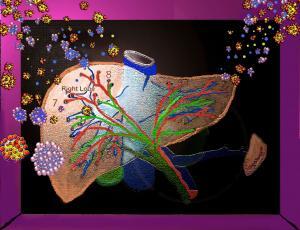DILI Expert Mellssa Palmer MD's drawing of a liver